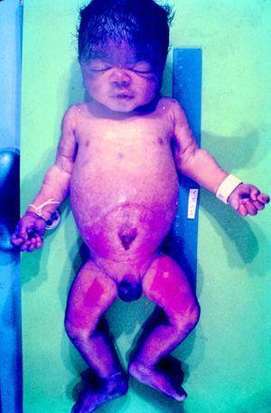 Rash cutáneo y abombamiento abdominal en recién nacido con sífilis congénita precoz que sobrevivió varios días.