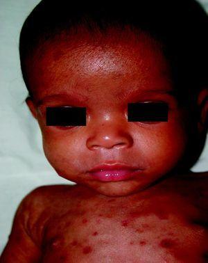 Lesiones peribucales características y abombamiento frontal por hidrocefalia en niño con sífilis congénita precoz.