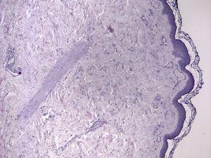 Hematoxilina-eosina 10x. Ectasia vascular en dermis papilar.