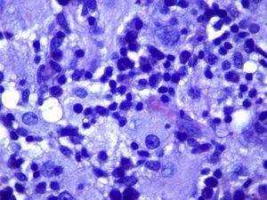Detalle histológico donde se observan histiocitos de citoplasmas eosinófilos y vacuolados y núcleos redondos y homogéneos. Algunos de estos histiocitos contenían linfocitos intactos en su interior (emperipolesis) (hematoxilina-eosina x400).