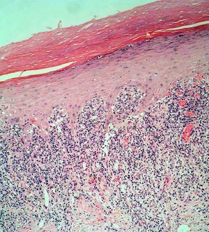 Imagen histológica del borde de la lesión. Infiltrado en banda linfocitario en dermis papilar y acentuada red de crestas interpapilares (HE.10x).