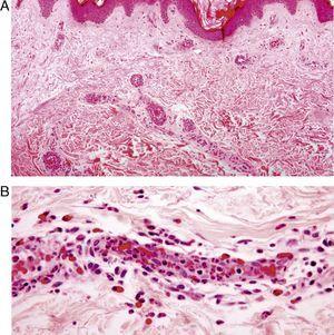 Venulitis neutrofílica. A. epidermis y dermis normal. Infiltrado inflamatorio en la pared de los vasos (H-E ×4). B. Presencia de polimorfonucleares neutrófilos y eosinófilos localizados en el interior de la pared de un vaso (H-E ×20).