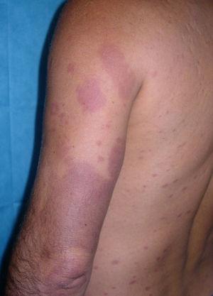 Empeoramiento de las lesiones previas y aparición de múltiples nódulos eritematovioláceos (leprorreacción tipo 2).