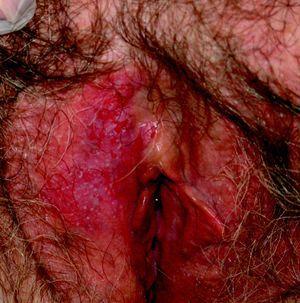 Placa eritematosa en la que se observan islotes blanquecinos y áreas erosivas en el labio mayor derecho de la vulva.