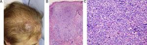 Caso 7: A. lesión tumoral eritemato-violácea en región frontal derecha, a nivel de la primera rama del trigémino. B. infiltración tumoral linfoide que ocupa la dermis superficial y profunda, formado grandes agrupaciones de aspecto folicular (hematoxilina-eosina x10). C. linfocitos atípicos de tamaño pequeño-intermedio que se disponen en agrupaciones foliculares (hematoxilina-eosina x20).