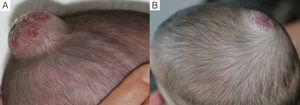 Caso 6. A. HI en cuero cabelludo antes del tratamiento.B. Respuesta excelente a los 6 meses de tratamiento.