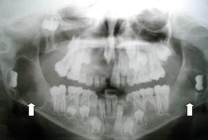 Caso 1. Rx panorámica de maxilares: queratoquistes odontógenos.