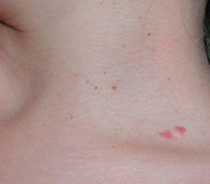 Caso 2: pápulas amarronadas de 3 a 5mm de diámetro en la cara lateral del cuello correspondientes a CBC.