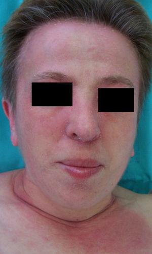 Dermatomiositis y cáncer de mama (eritema facial).