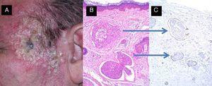 Linfangitis carcinomatosa secundaria a carcinoma epidermoide previamente extirpado de la sien izquierda. A. Desarrollo de múltiples papulo-vesículas en la sien izquierda. B y C. Invasión de vasos linfáticos por células escamosas atípicas (B: hematoxilina-eosina, x40; C: tinción inmunohistoquímica D2-40, x40).