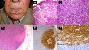 Carcinoma epidermoide de alto riesgo sometido a ganglio centinela. A. Varón de 65 años con carcinoma epidermoide en el labio inferior. B y C. Proliferación escamosa atípica invasiva con acantólisis e invasión perineural. D-F. Invasión del ganglio centinela por células escamosas atípicas (D: hematoxilina-eosina x40; E: hematoxilina-eosina x100; F: inmunotinción con panqueratina x100).