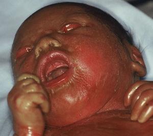 Bebé colodión que posteriormente evolucionó a un fenotipo de IL.