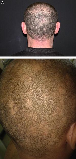 Alopecia en placas en la región parietooccipital que adopta un característico patrón apolillado (A, caso 2) o en trasquilones (B, caso 5).