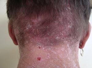 Múltiples lesiones descamativas en la región occipital asociadas a una alopecia difusa extensa en un paciente con infección por el VIH (caso 1).