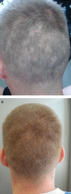 Evolución clínica en el caso 4. A. Alopecia apolillada previa al tratamiento. B. Control 3 meses después del inicio del tratamiento con evidente mejoría.