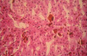 Depósitos intracanaliculares de material pigmentado (protoporfirinas) en un paciente con protoporfiria eritropoyética y hepatopatía colestásica.
