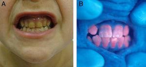 A. Tinción amarillenta de los dientes de un niño con porfiria eritropoyética congénita. B. La fluorescencia roja (eritrodoncia) se hace evidente con una luz de Wood.