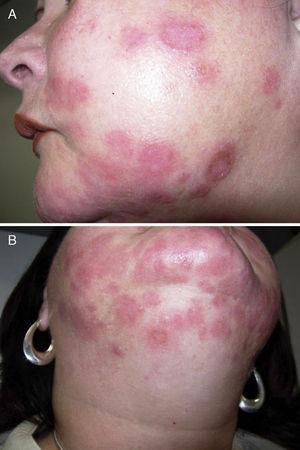 Facial lesions (A-Lateral; B-Inferior) multiple symmetrically distributed edematous papules on bilateral cheeks and chin.