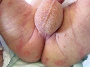 Pústulas en las nalgas y los muslos. Las lesiones rotas se corresponden con máculas pigmentadas.