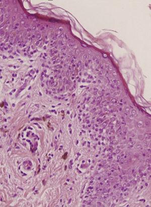 Queratinocitos necróticos, dermatitis de interfase vacuolar, infiltrado inflamatorio de predominio linfohistiocitario con aislados eosinófilos y macrófagos cargados de hemosiderina. Hematoxilina-eosina 200X.
