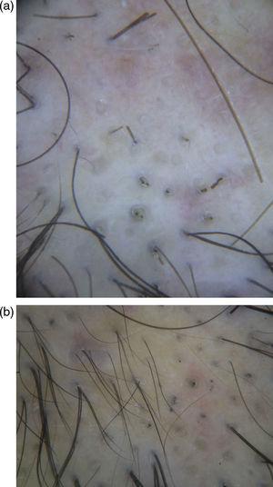 (a) Dermoscopy showing yellow dots, empty follicular openings, black dots and cadaverized hairs, very similar to AA. Exclamation mark hairs were absent (dermoscopy, at 40× magnification). (b) Dermoscopy of follow-up, showing short regrowing hairs and dystrophic hairs (dermoscopy, at 70× magnification).