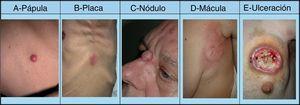 Lesiones cutáneas elementales en la manifestación clínica de las metástasis cutáneas. A. Metástasis de adenocarcinoma gástrico. Pápula de 7mm en abdomen. B. Metástasis de adenocarcinoma de ovario en forma de placa. C. Metástasis de carcinoma urotelial vesical en forma de nódulo. D. Metástasis de adenocarcinoma de mama que comenzó como una mácula sobre la cicatriz de una mastectomía previa. E. Placa infiltrada ulcerada correspondiente a una metástasis de un adenocarcinoma pulmonar.