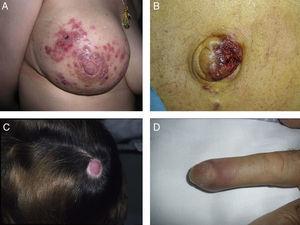 Metástasis cutáneas peculiares. A. Metástasis zosteriforme de un adenocarcinoma ductal de mama. Pápulas infiltradas, agrupadas en racimo y confluentes, algunas ulceradas con distribución metamérica. B. Metástasis umbilical (nódulo de la hermana María José). Múltiples pápulas y nódulos, confluentes, con ulceración en la región umbilical y periumbilical. C. Metástasis alopécica. Placa alopécica en una mujer, correspondiente a una metástasis de adenocarcinoma ductal mamario. D. Metástasis subungueal. Nódulo inflamatorio doloroso, con deformidad en la región de la falange distal, en el segundo dedo de la mano izquierda, correspondiente a una metástasis de carcinoma epidermoide pulmonar.