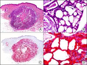 Carcinoma cribiforme primario cutáneo. A. Visión panorámica (x10). B. Detalle del patrón cribiforme de los islotes epiteliales de la neoplasia (x400). C. El mismo caso estudiado inmunohistoquímicamente con CEA (x10). D. Detalle de la positividad para el CEA de las células neoplásicas (D x400).
