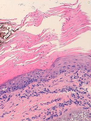 Hematoxilina-eosina 20×. Laminilla cornoide (columna de paraqueratosis asociada a hipogranulosis y disqueratosis.
