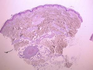 Sin alteraciones en epidermis ni dermis superficial, llamativos manguitos linfocitarios en arteriolas de dermis reticular y zona superficial de hipodermis (hematoxilina-eosina ×20).