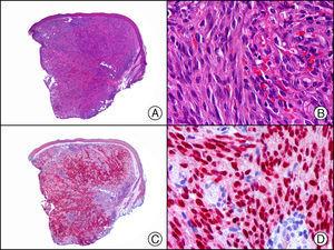 Sarcoma de Kaposi en fase nodular. A) Visión panorámica. B) Detalle de la morfología fusiforme de las células neoplásicas con algunos hematíes entre ellas. C) El mismo caso estudiado inmunohistoquímicamente con HHV-8. D) Positividad de la mayoría de los núcleos de las células neoplásicas para el HHV-8.