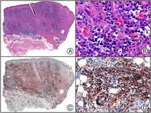 Linfoma NK de tipo nasal. A) Visión panorámica mostrando una infiltración difusa de todo el espesor de la dermis. B) A gran aumento se observan linfocitos pleomórficos de tamaño mediano. C) El mismo caso estudiado inmunohistoquímicamente con CD56. D) Detalle de la positividad para CD56 de los linfocitos neoplásicos.