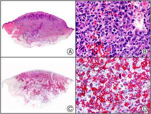 Papulosis linfomatoide tipo A. A) Visión panorámica. B) Linfocitos atípicos y pleomórficos, algunos de ellos en mitosis. C) El mismo caso estudiado inmunohistoquímicamente con CD30. D) Intensa positividad para el CD30 en los linfocitos atípicos.