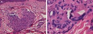 A) Imagen histopatológica de la biopsia de una pápula del hombro mostrando granulomas sarcoideos en la dermis reticular (HE×200). B) Detalle de las partículas brillantes en el citoplasma de las células gigantes multinucleadas (HE×400).