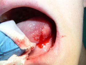 Lesión sésil de superficie verrucosa blanquecina en la cara lateral izquierda de la lengua.