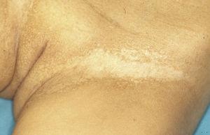 Síndrome AEC: alteraciones de la pigmentación en el pliegue inguinal, con zonas de hipopigmentación en la zona central del pliegue y áreas de hiperpigmentación reticulada en la zona periférica y la vulva.