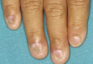 Síndrome AEC: alteraciones ungueales de distinta severidad en las uñas de la mano.