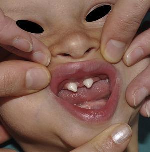 DE hipohidrótica: agenesia dental y característicos dientes cónicos.