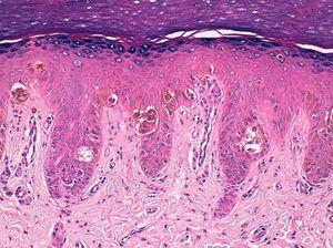 Hiperplasia epidérmica y proliferación de melanocitos de núcleo pequeño, sin atipia ni pleomorfismo, dispuestos en nidos de tamaño variable en la porción inferior del epitelio y también en forma de células individuales con patrón pagetoide en los niveles altos del epitelio (hematoxilina-eosina x 100).