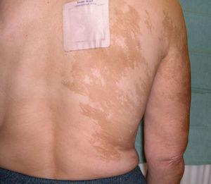 Lesiones maculosas de color pardo homogéneo, de configuración reticulada sobre piel normal, en zona derecha de espalda sin atravesar la línea media.
