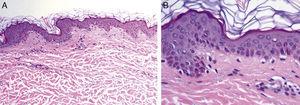 A) En epidermis, aumento de pigmentación en las células de la capa basal (hematoxilina-eosina, × 100). B) A mayor detalle, pigmentación citoplasmática en células de la capa basal epidérmica (hematoxilina-eosina, × 400).