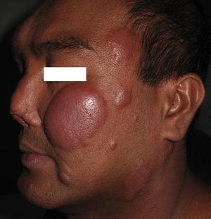 Placas eritematoedematosas faciales en una leprorreacción de tipo i.