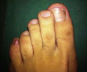 Fibroqueratoma acral en el quinto dedo del pie izquierdo.