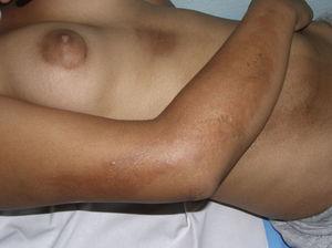 Ejemplo de morfea mixta: se observa una lesión lineal que ocupa la mayor parte de la extremidad superior junto a lesiones de morfea en placa en el abdomen.