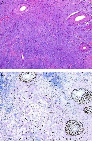 A. Dermis sustituida por colágeno denso englobando células fusiformes de aspecto mesenquimal. (HE × 100.) B. La positividad para p63 demuestra un origen epitelial y permite el diagnóstico de carcinoma escamoso fusocelular. (p63 [inmunohistoquímica] × 100.)