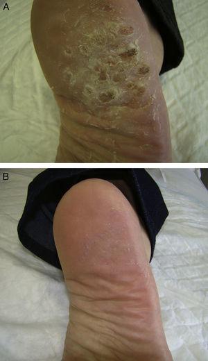 A. Paciente 1: Múltiples verrugas víricas agrupadas en mosaico sobre el talón del pie derecho. B. Paciente 1: 8 semanas después del tratamiento.