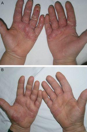 Ejemplo de paciente con psoriasis en las palmas. A. Antes del tratamiento. B. Después del tratamiento.