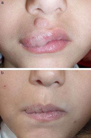A. Paciente número 4 con hemangioma infantil en involución localizado en el labio superior previo al tratamiento. B. Mejoría marcada sin cicatrices residuales tras una sesión de tratamiento, a pesar de la ulceración en la mucosa labial tras la terapia.