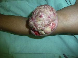 Lesión tumoral exofítica pediculada, con superficie erosionada y sangrante.
