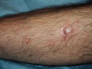 Imagen de un paciente con un linfoma de la zona marginal en la pierna.